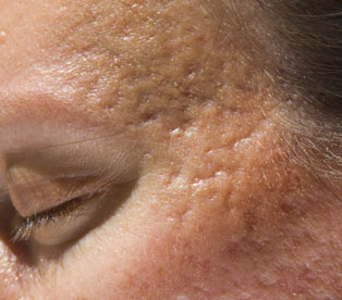 Cicatrices de acné Epidermos Instituto de dermoestética