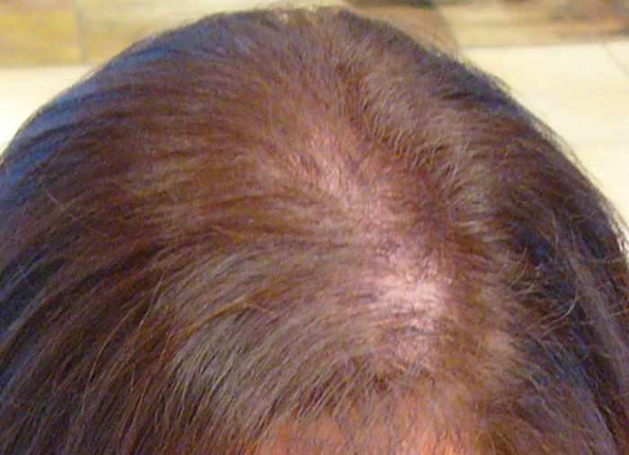nuevos-tratamientos-alopecia-dutasteride-lamparas-led-domiciliarias-mixoxidil-finasterida