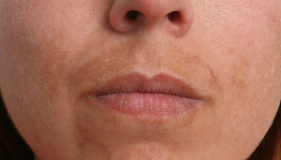 melasma_tranexamico