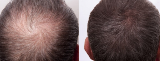 Dutasteride en Microneedling