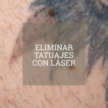 eliminar_tatuajes_con_laser
