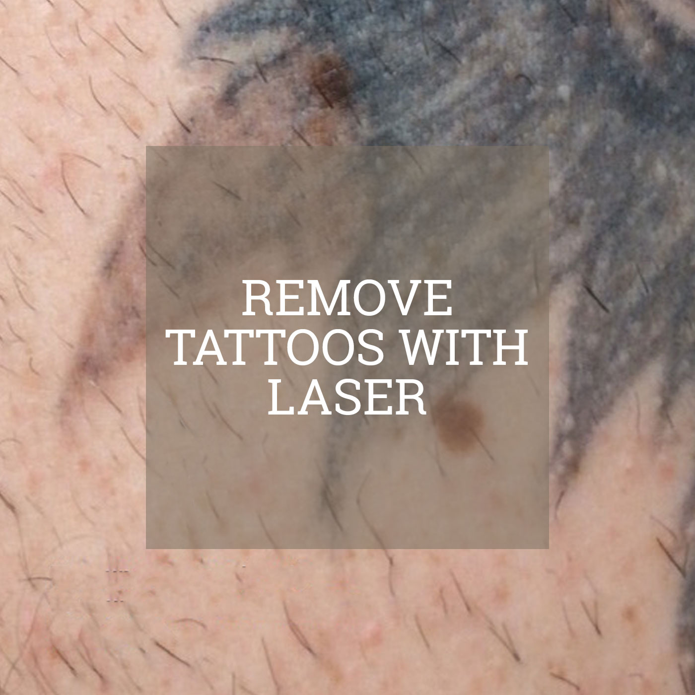 Remove tattoos with laser - Epidermos Instituto de dermoestética
