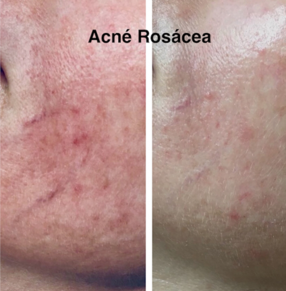 acne-rosacea