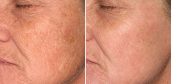 láser para arrugas y rejuvenecimiento facial.