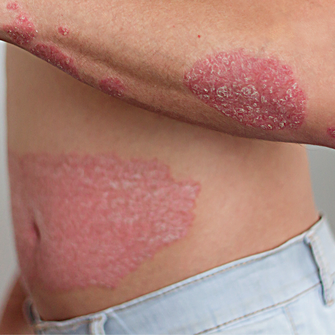 Dermatitis seborreica: ¿Cómo diferenciarla de la psoriasis o